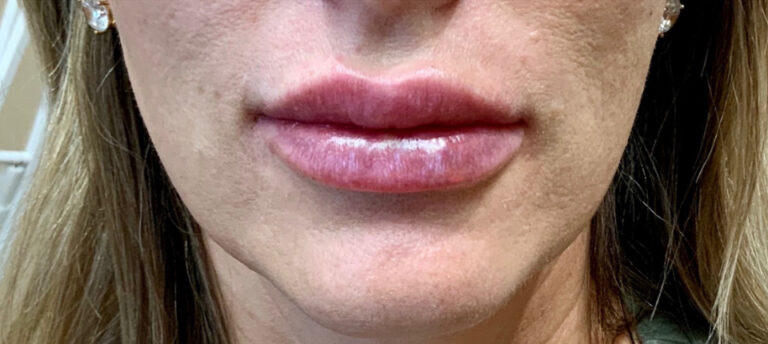 After Image: Juvederm - front