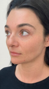 Before Image: Lip and Cheek Filler