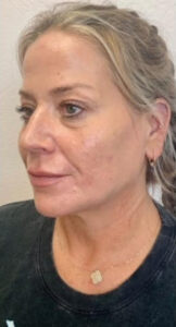 After Image: Liquid Facelift