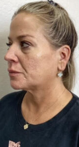 Before Image: Liquid Facelift