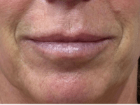 Before Image: Lip Injections