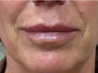 After Image: Lip Injections